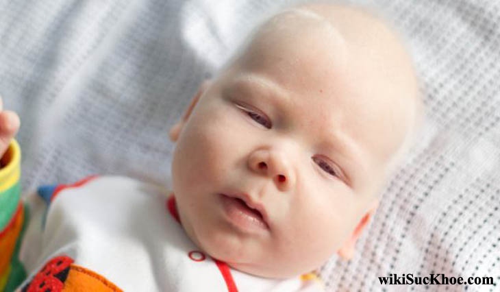 Bệnh nhân nhiễm bạch tạng